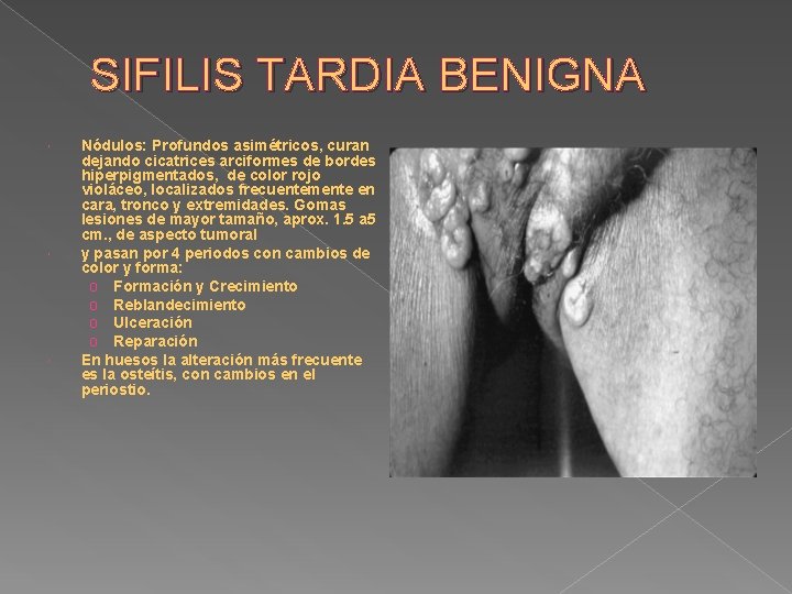 SIFILIS TARDIA BENIGNA Nódulos: Profundos asimétricos, curan dejando cicatrices arciformes de bordes hiperpigmentados, de