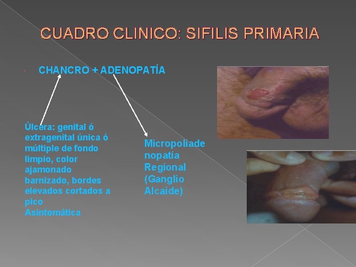 CUADRO CLINICO: SIFILIS PRIMARIA CHANCRO + ADENOPATÍA Úlcera: genital ó extragenital única ó múltiple