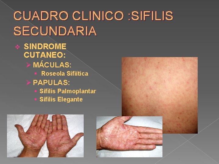 CUADRO CLINICO : SIFILIS SECUNDARIA v SINDROME CUTANEO: Ø MÁCULAS: § Roseola Sifiítica Ø