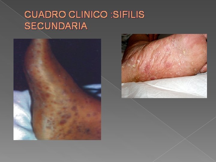 CUADRO CLINICO : SIFILIS SECUNDARIA 