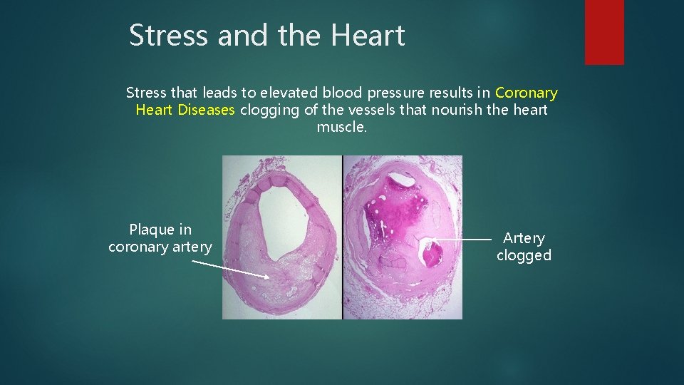 Stress and the Heart Stress that leads to elevated blood pressure results in Coronary