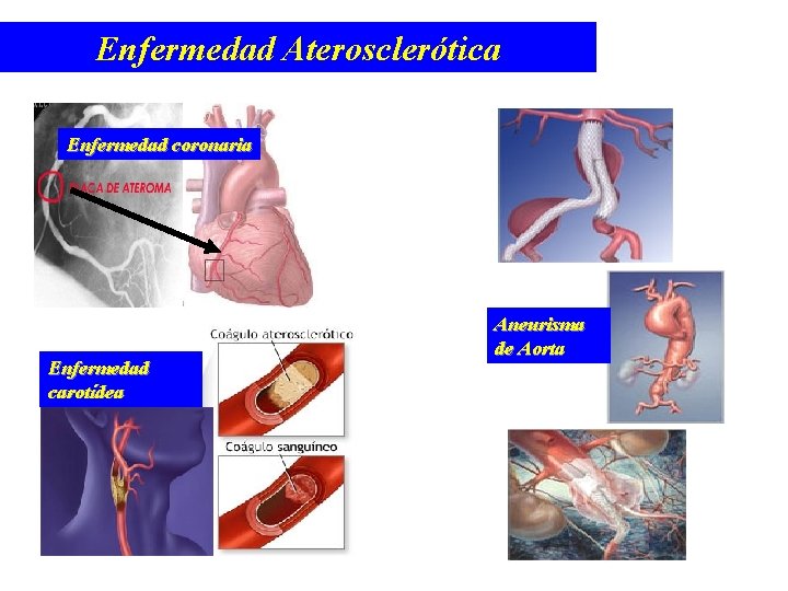 Enfermedad Aterosclerótica Enfermedad coronaria Enfermedad carotídea Aneurisma de Aorta 