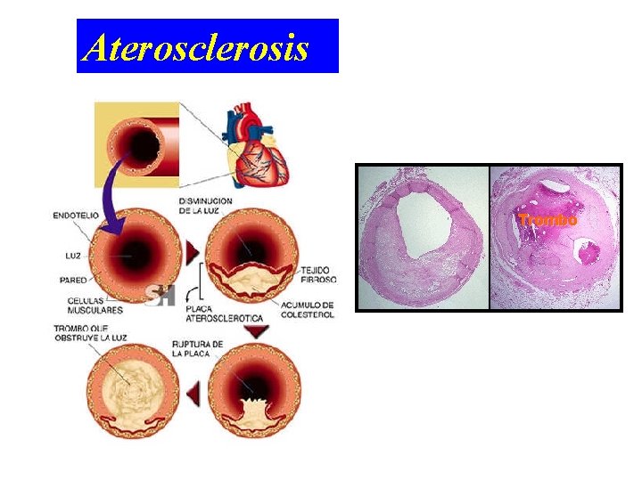 Aterosclerosis Trombo 