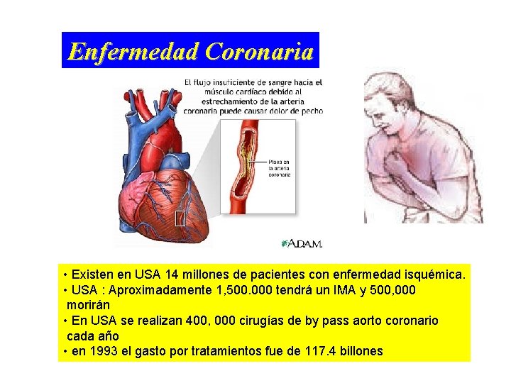 Enfermedad Coronaria • Existen en USA 14 millones de pacientes con enfermedad isquémica. •