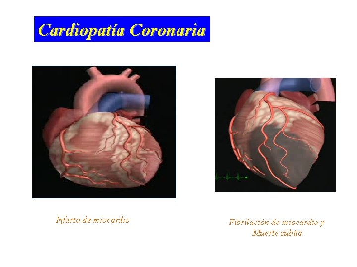 Cardiopatía Coronaria Infarto de miocardio Fibrilación de miocardio y Muerte súbita 