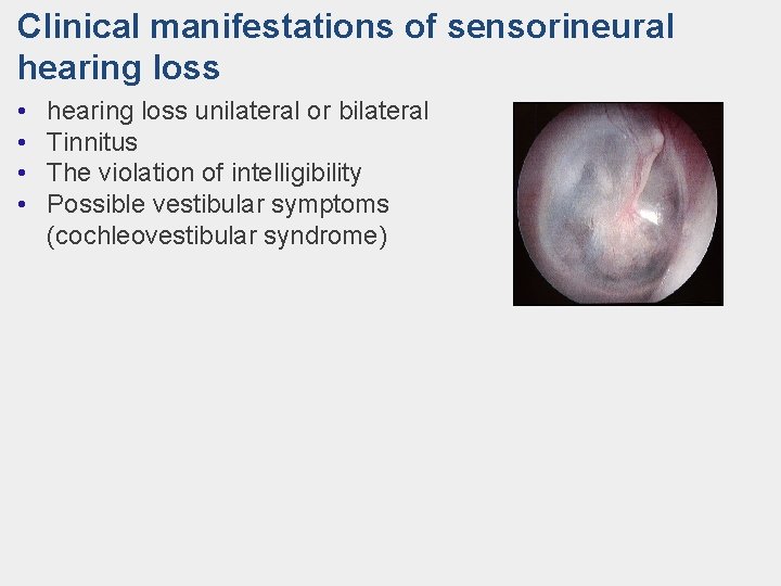 Clinical manifestations of sensorineural hearing loss • • hearing loss unilateral or bilateral Tinnitus