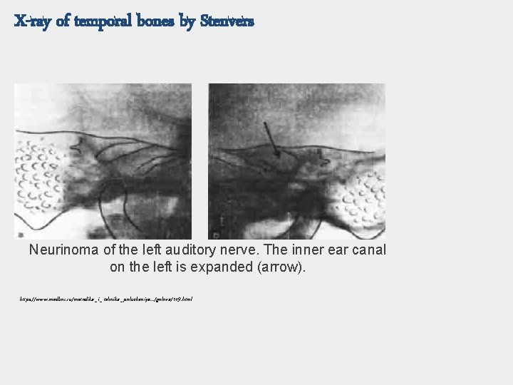 X-ray of temporal bones by Stenvers Neurinoma of the left auditory nerve. The inner