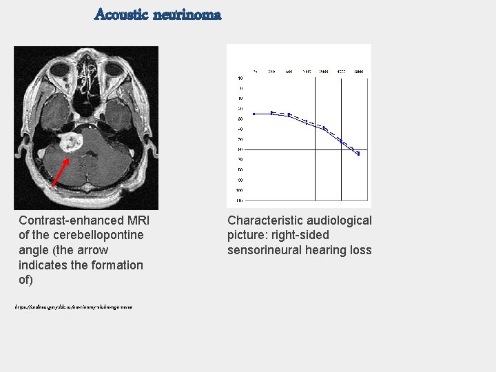 Acoustic neurinoma Contrast-enhanced MRI of the cerebellopontine angle (the arrow indicates the formation of)