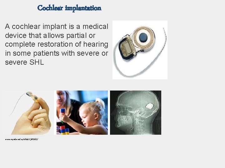 Cochlear implantation A cochlear implant is a medical device that allows partial or complete