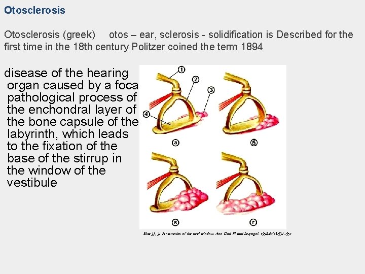 Otosclerosis (greek) otos – ear, sclerosis - solidification is Described for the first time