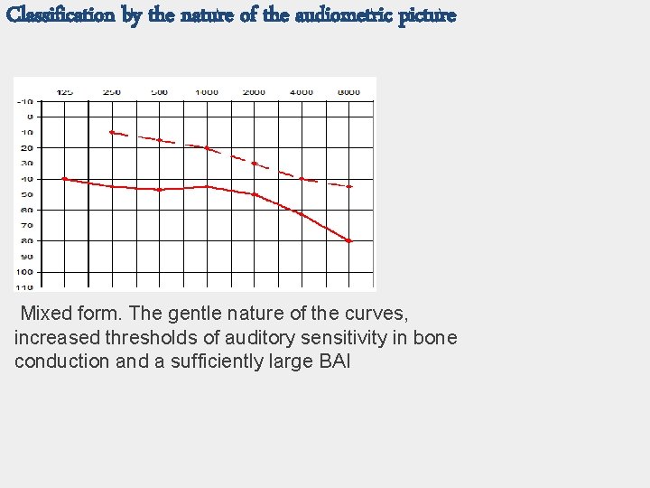 Classification by the nature of the audiometric picture Mixed form. The gentle nature of