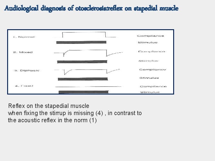 Audiological diagnosis of otosclerosis: reflex on stapedial muscle Reflex on the stapedial muscle when