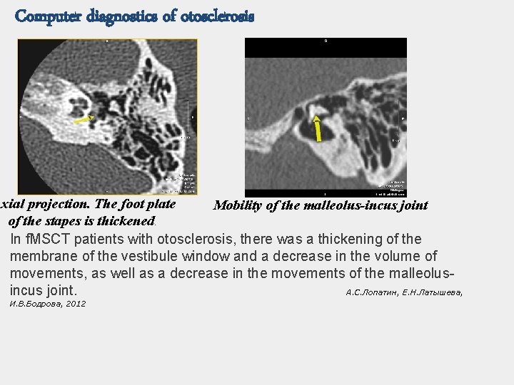 Computer diagnostics of otosclerosis Axial projection. The foot plate Mobility of the malleolus-incus joint