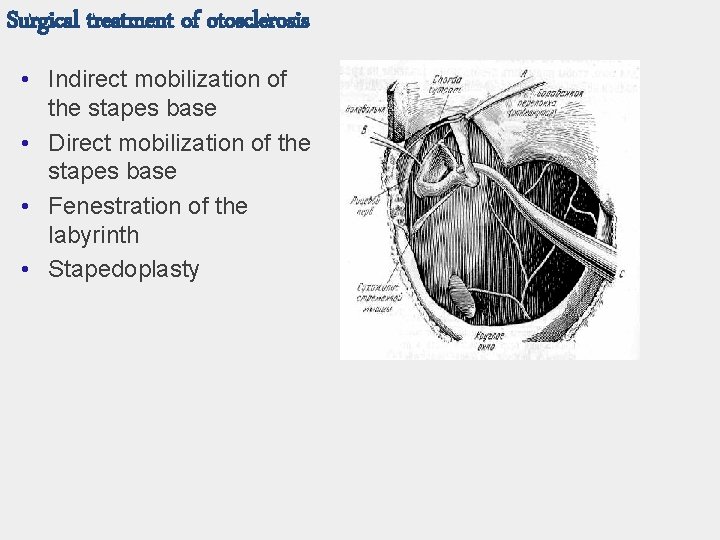 Surgical treatment of otosclerosis • Indirect mobilization of the stapes base • Direct mobilization