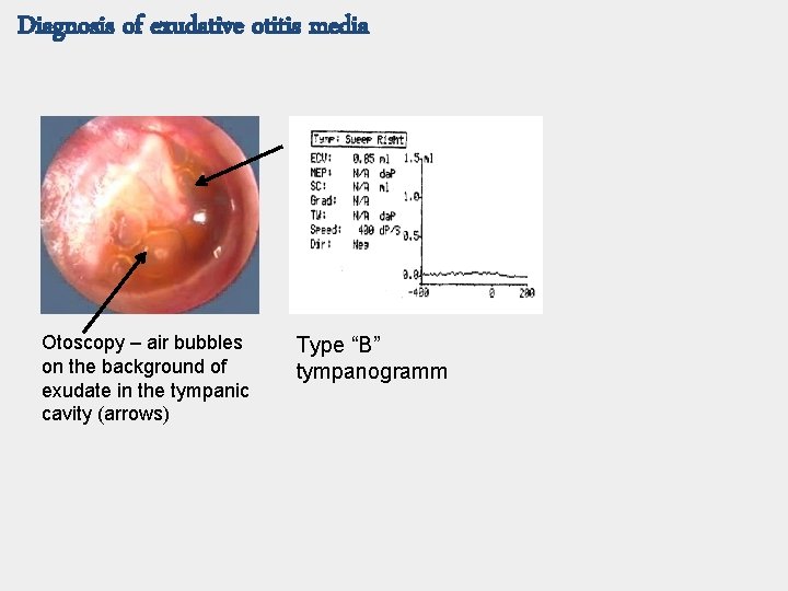 Diagnosis of exudative otitis media Otoscopy – air bubbles on the background of exudate