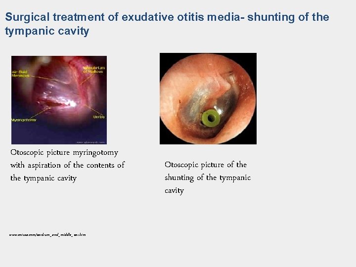 Surgical treatment of exudative otitis media- shunting of the tympanic cavity Otoscopic picture myringotomy