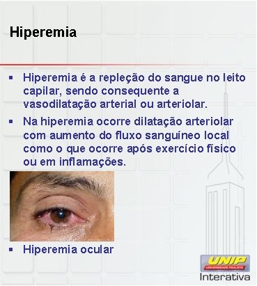 Hiperemia § Hiperemia é a repleção do sangue no leito capilar, sendo consequente a