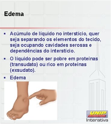 Edema § Acúmulo de líquido no interstício, quer seja separando os elementos do tecido,