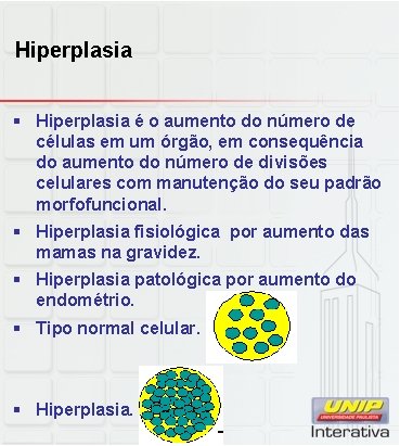 Hiperplasia § Hiperplasia é o aumento do número de células em um órgão, em