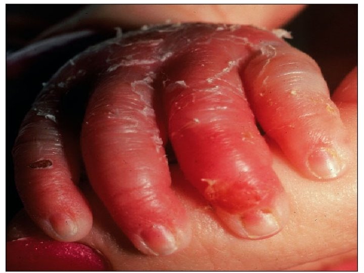 Impetigo of the n newborn Toxemia n Scalded skin • syndrome Toxic shock •