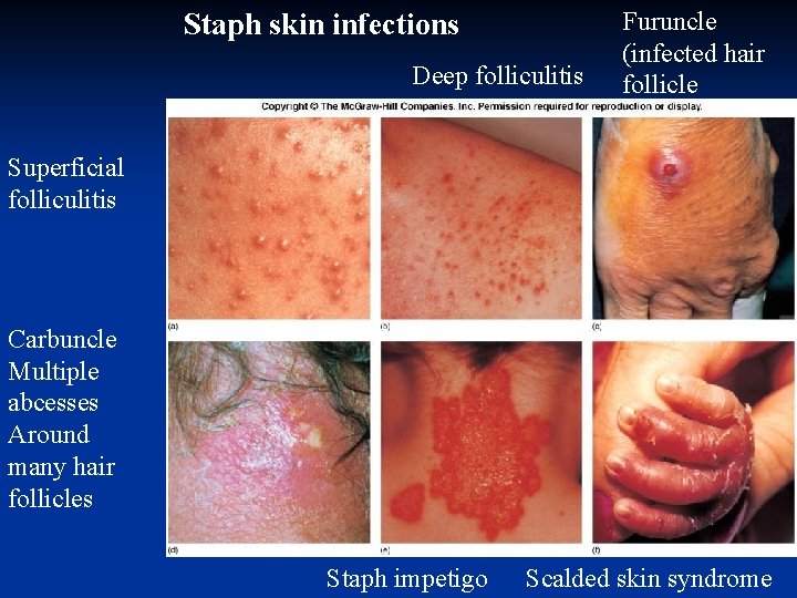 Staph skin infections Deep folliculitis Furuncle (infected hair follicle Superficial folliculitis Carbuncle Multiple abcesses