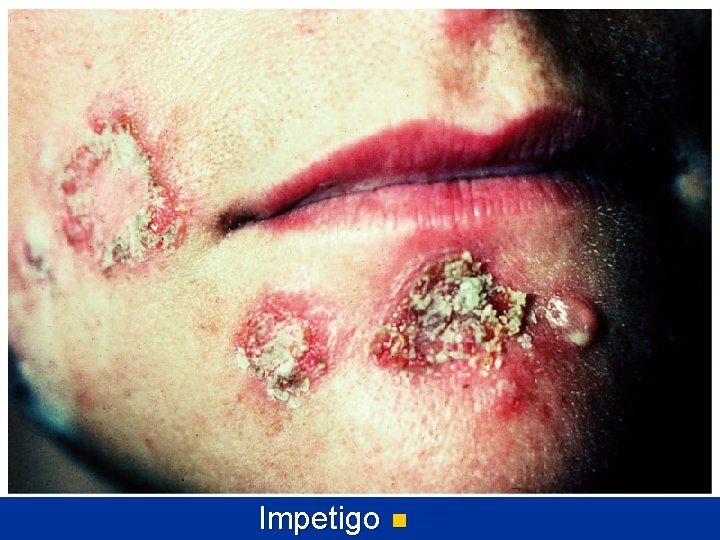 Impetigo n 