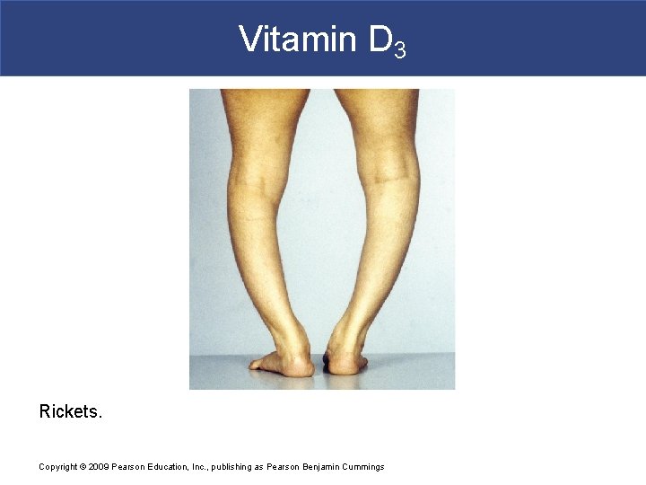 Vitamin D 3 Rickets. Copyright © 2009 Pearson Education, Inc. , publishing as Pearson