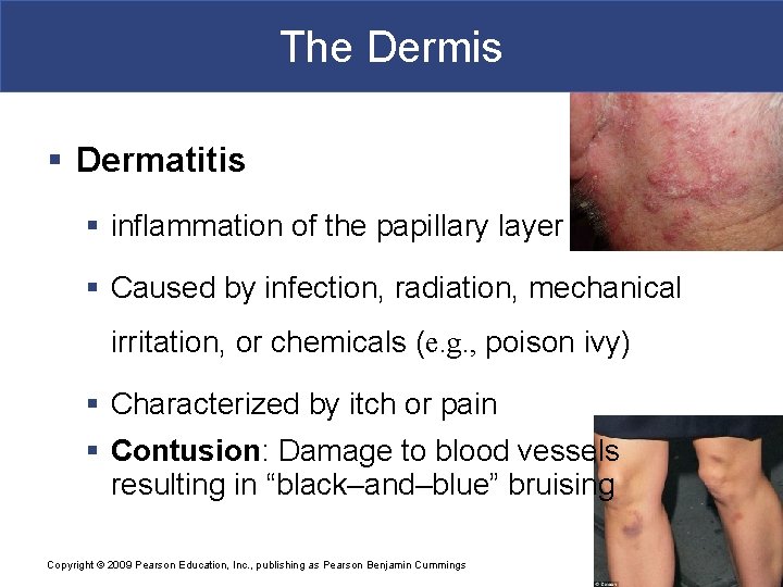 The Dermis § Dermatitis § inflammation of the papillary layer § Caused by infection, The Dermis § Dermatitis § inflammation of the papillary layer § Caused by infection,