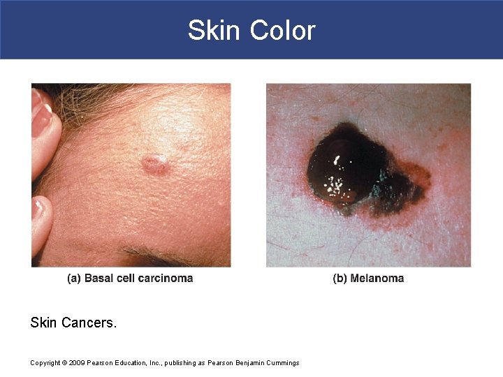 Skin Color Skin Cancers. Copyright © 2009 Pearson Education, Inc. , publishing as Pearson