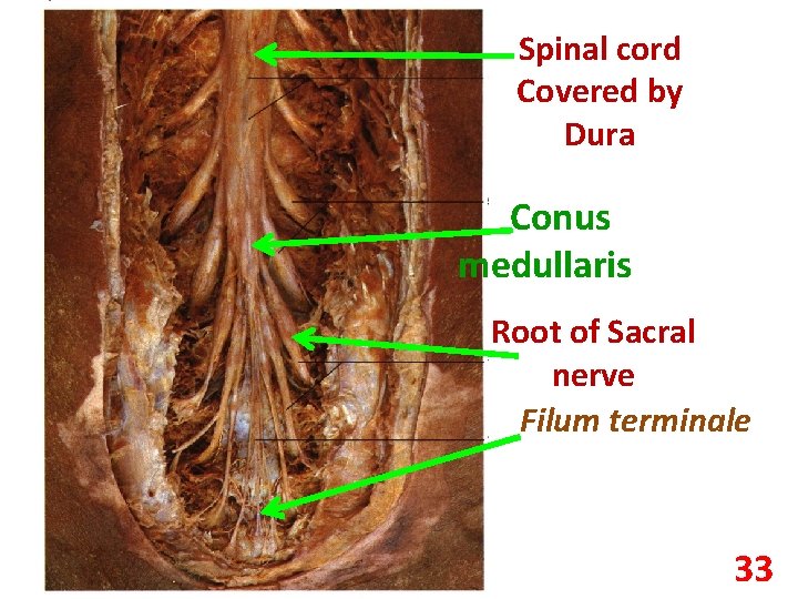 Spinal cord Covered by Dura Conus medullaris Root of Sacral nerve Filum terminale 33