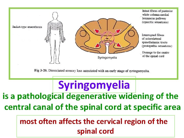 Syringomyelia is a pathological degenerative widening of the central canal of the spinal cord