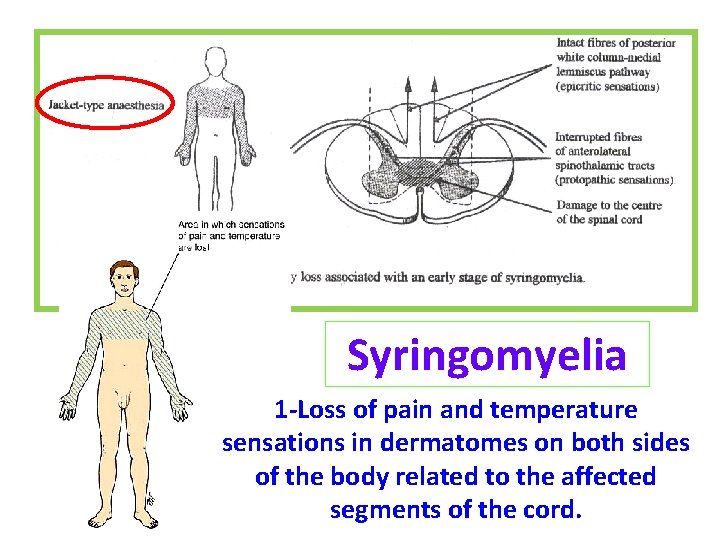 Syringomyelia 1 -Loss of pain and temperature sensations in dermatomes on both sides of