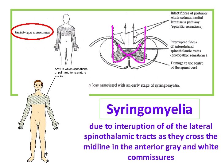 Syringomyelia due to interuption of of the lateral spinothalamic tracts as they cross the