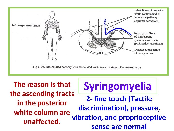 The reason is that Syringomyelia the ascending tracts 2 - fine touch (Tactile in