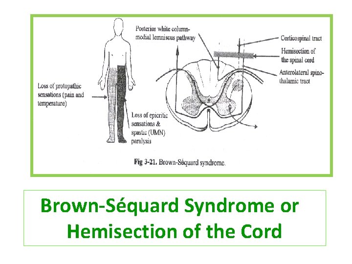 Brown-Séquard Syndrome or Hemisection of the Cord 
