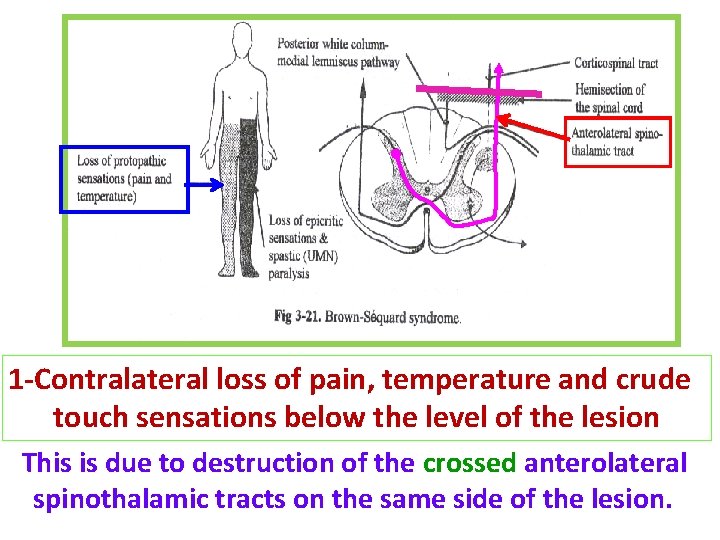 1 -Contralateral loss of pain, temperature and crude touch sensations below the level of