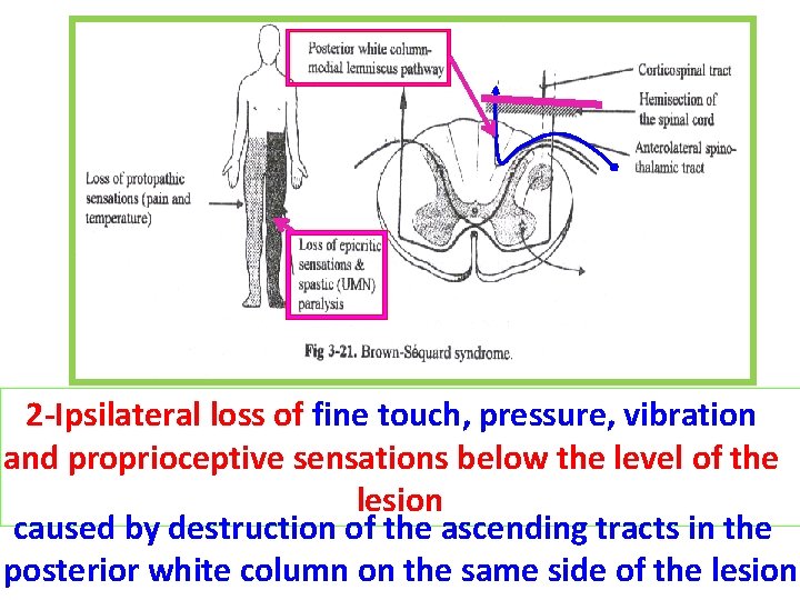 2 -Ipsilateral loss of fine touch, pressure, vibration and proprioceptive sensations below the level
