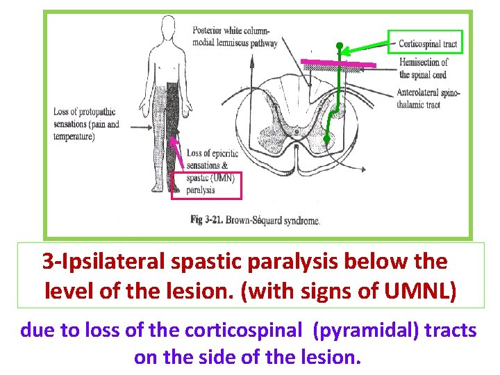 3 -Ipsilateral spastic paralysis below the level of the lesion. (with signs of UMNL)