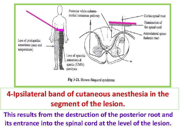 4 -Ipsilateral band of cutaneous anesthesia in the segment of the lesion. This results