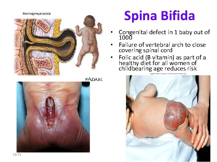 Spina Bifida • Congenital defect in 1 baby out of 1000 • Failure of
