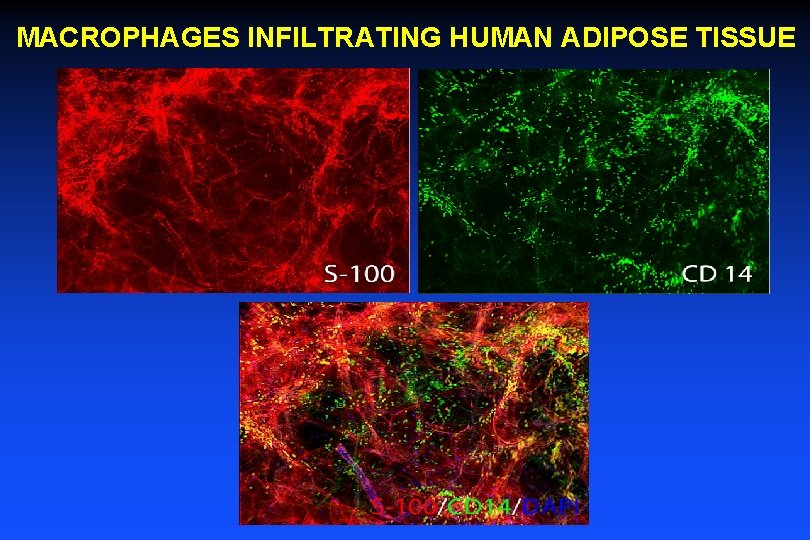 MACROPHAGES INFILTRATING HUMAN ADIPOSE TISSUE 