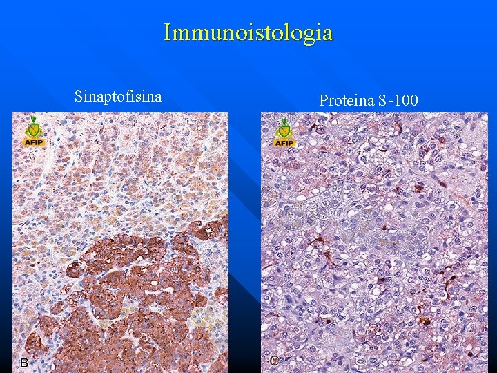 Immunoistologia Sinaptofisina Proteina S-100 