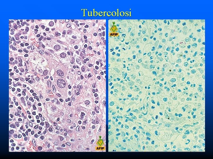 Tubercolosi 