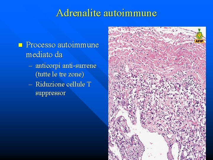 Adrenalite autoimmune n Processo autoimmune mediato da – anticorpi anti-surrene (tutte le tre zone)