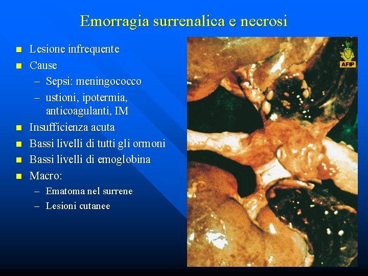 Emorragia surrenalica e necrosi n n n Lesione infrequente Cause – Sepsi: meningococco –