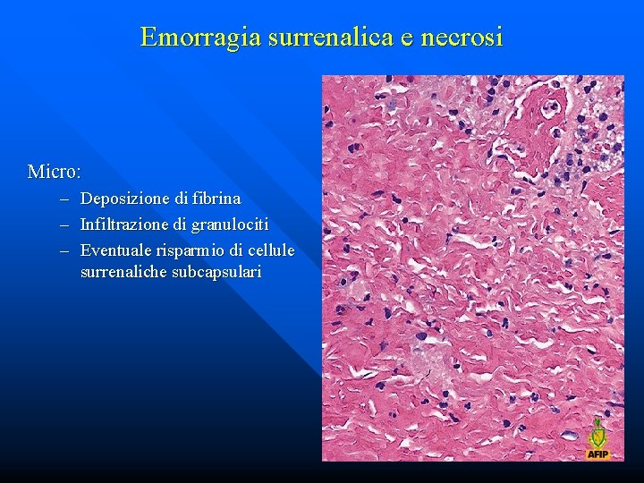 Emorragia surrenalica e necrosi Micro: – Deposizione di fibrina – Infiltrazione di granulociti –