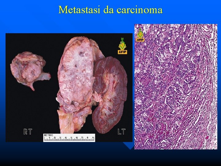 Metastasi da carcinoma 