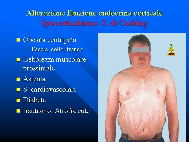 Alterazione funzione endocrina corticale Ipercorticalismo: S. di Cushing n Obesità centripeta – Faccia, collo,