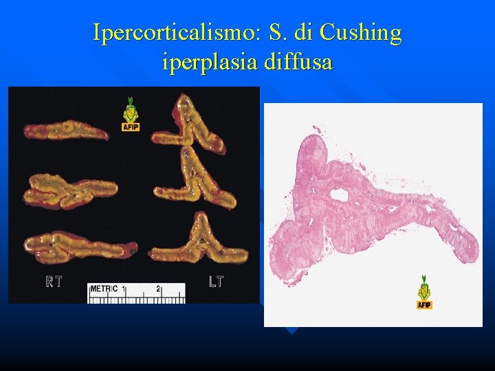 Ipercorticalismo: S. di Cushing iperplasia diffusa 