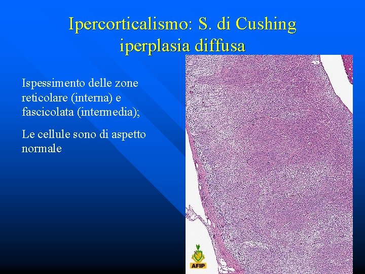 Ipercorticalismo: S. di Cushing iperplasia diffusa Ispessimento delle zone reticolare (interna) e fascicolata (intermedia);